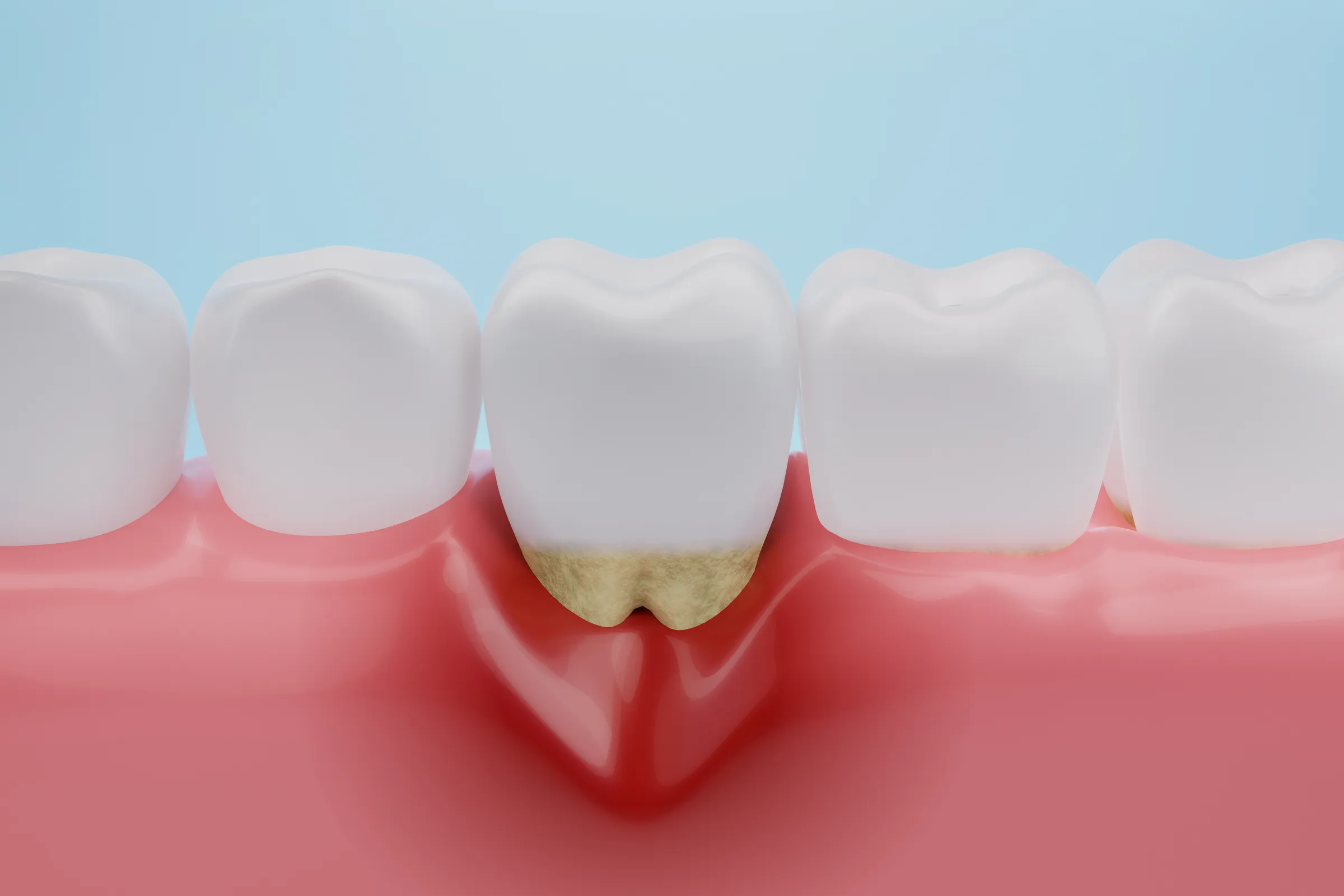Patient recovering after periodontal gum surgery