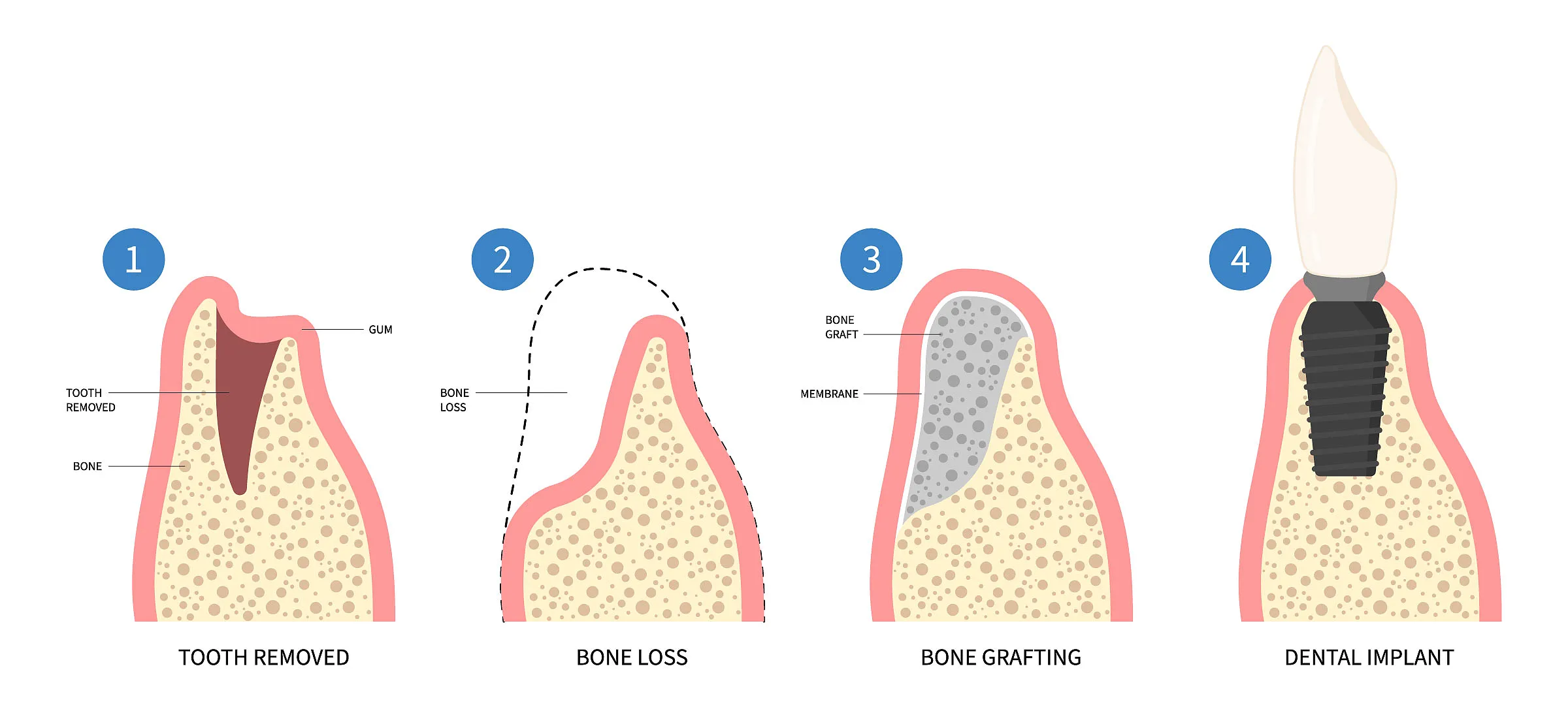 Patient during a follow-up visit after bone grafting