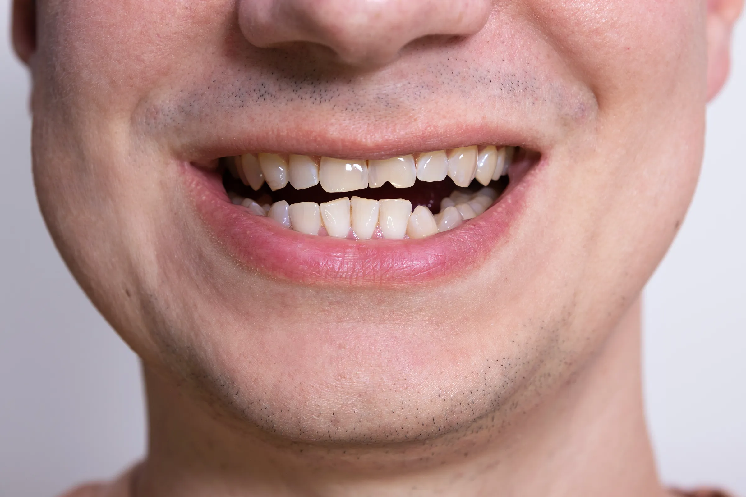 Close-up of a chipped front tooth