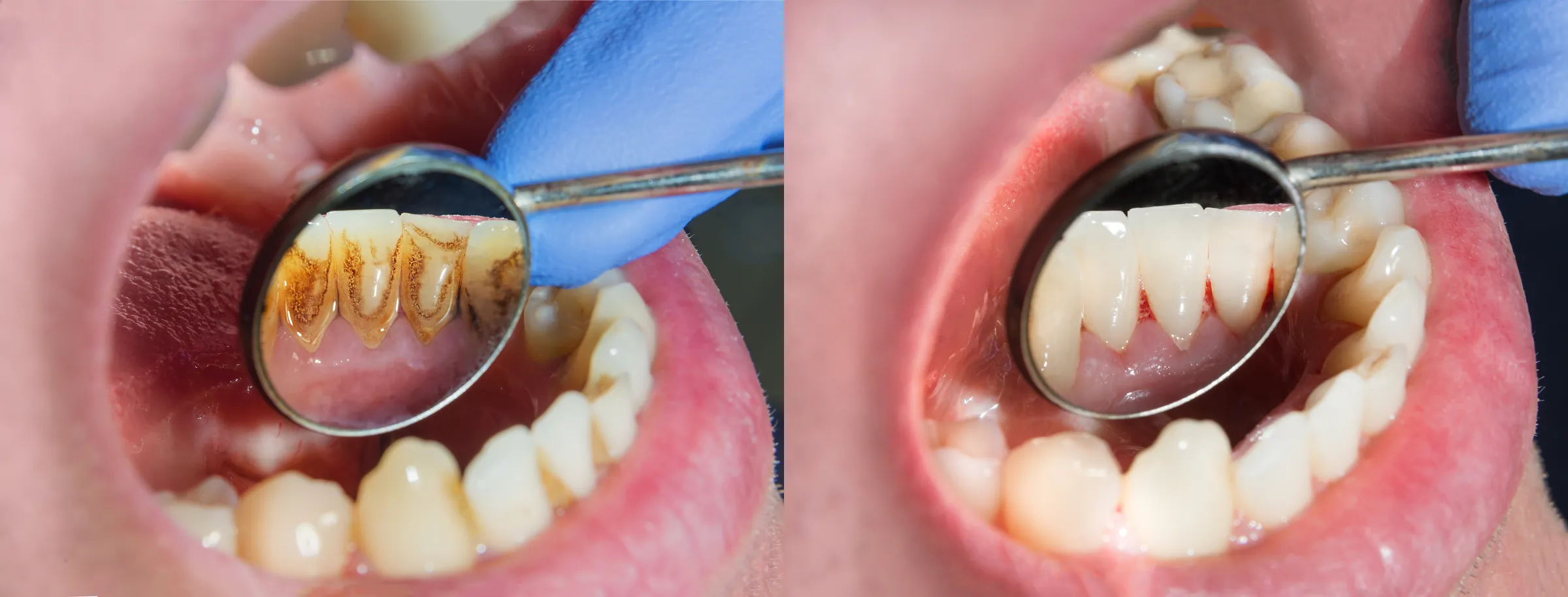 Hygienist cleaning a patient's teeth