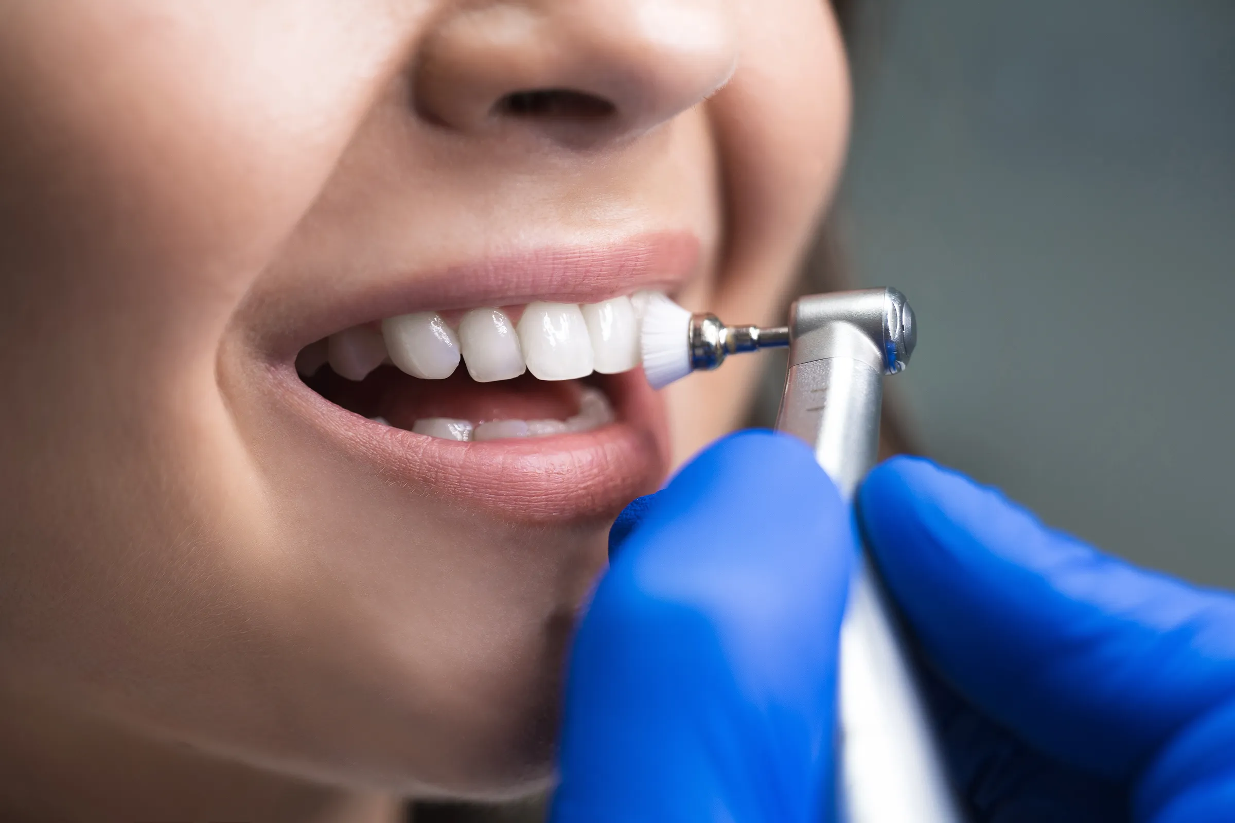 A dental hygienist polishing a patient’s teeth during a cleaning