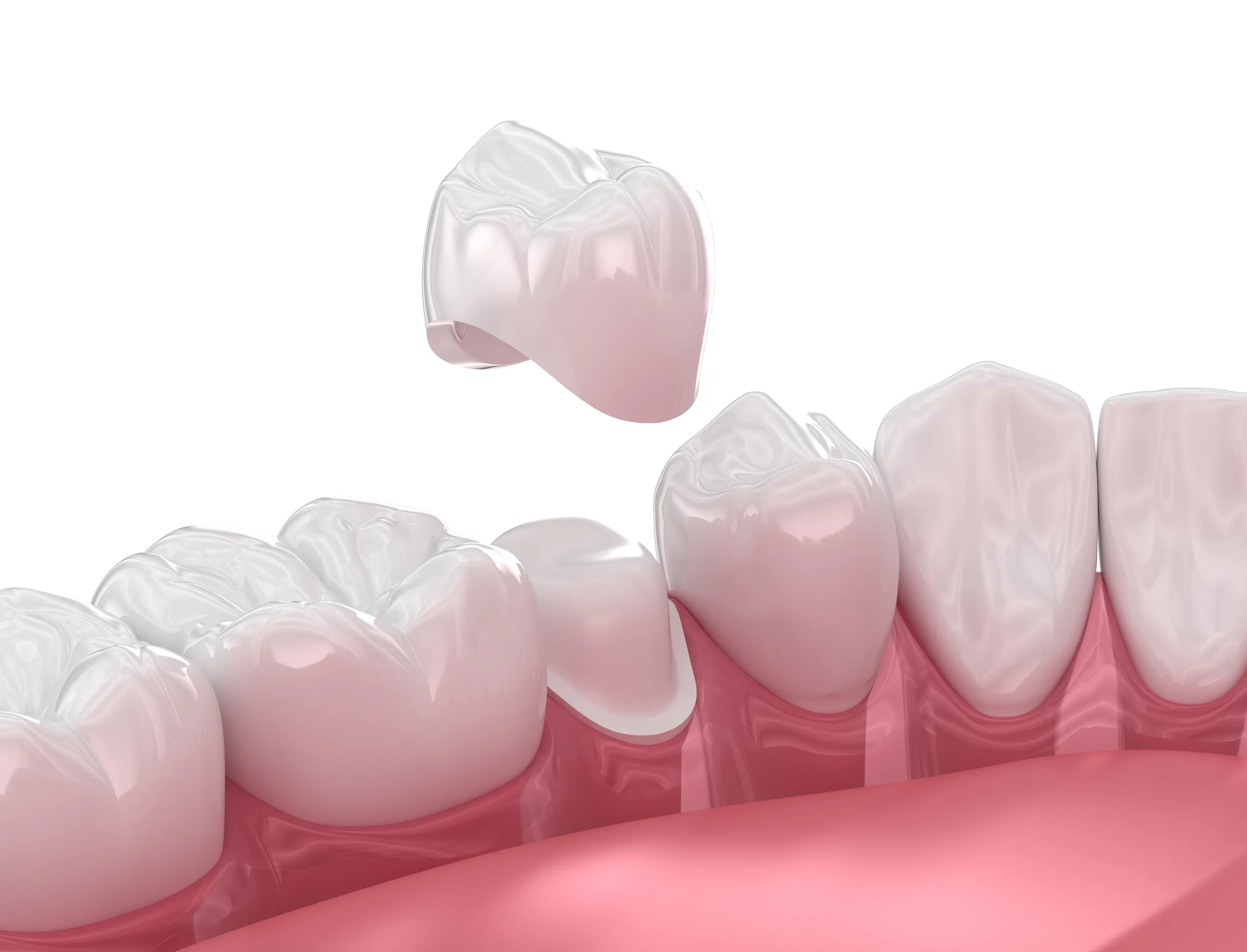Dental crown placed over a treated tooth