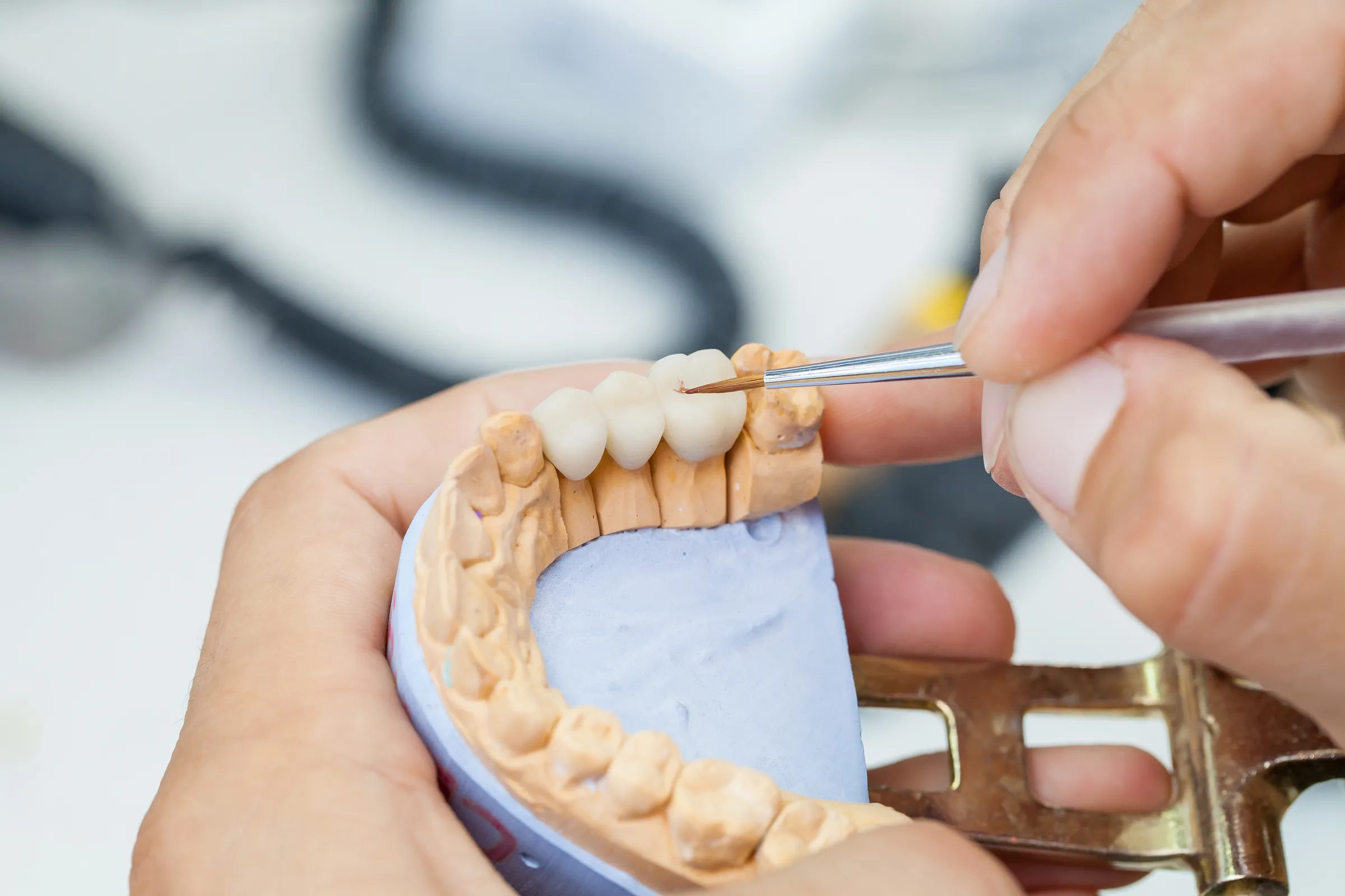 Dentist examining a patient's crown preparation