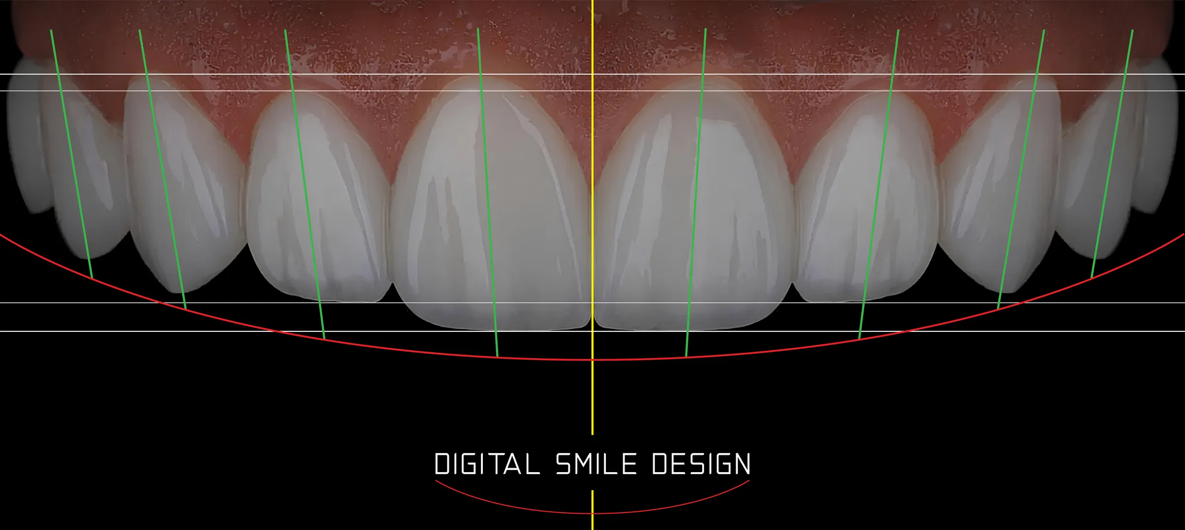A digital smile design in progress on a chairside monitor.