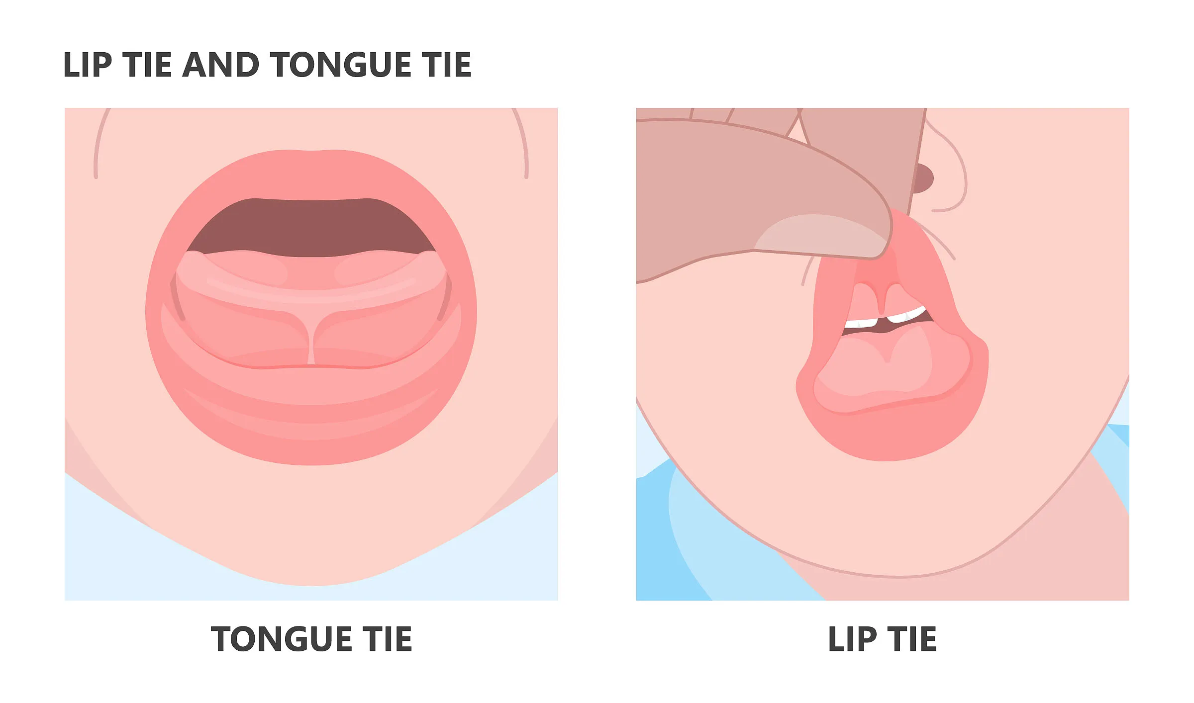 Patient during a follow-up visit after frenectomy