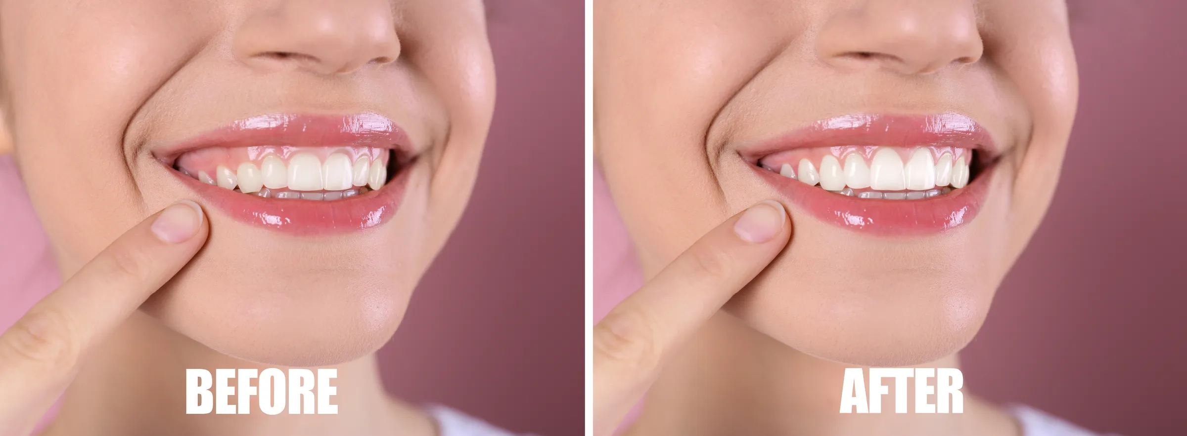 Patient smiling after a gum contouring consultation