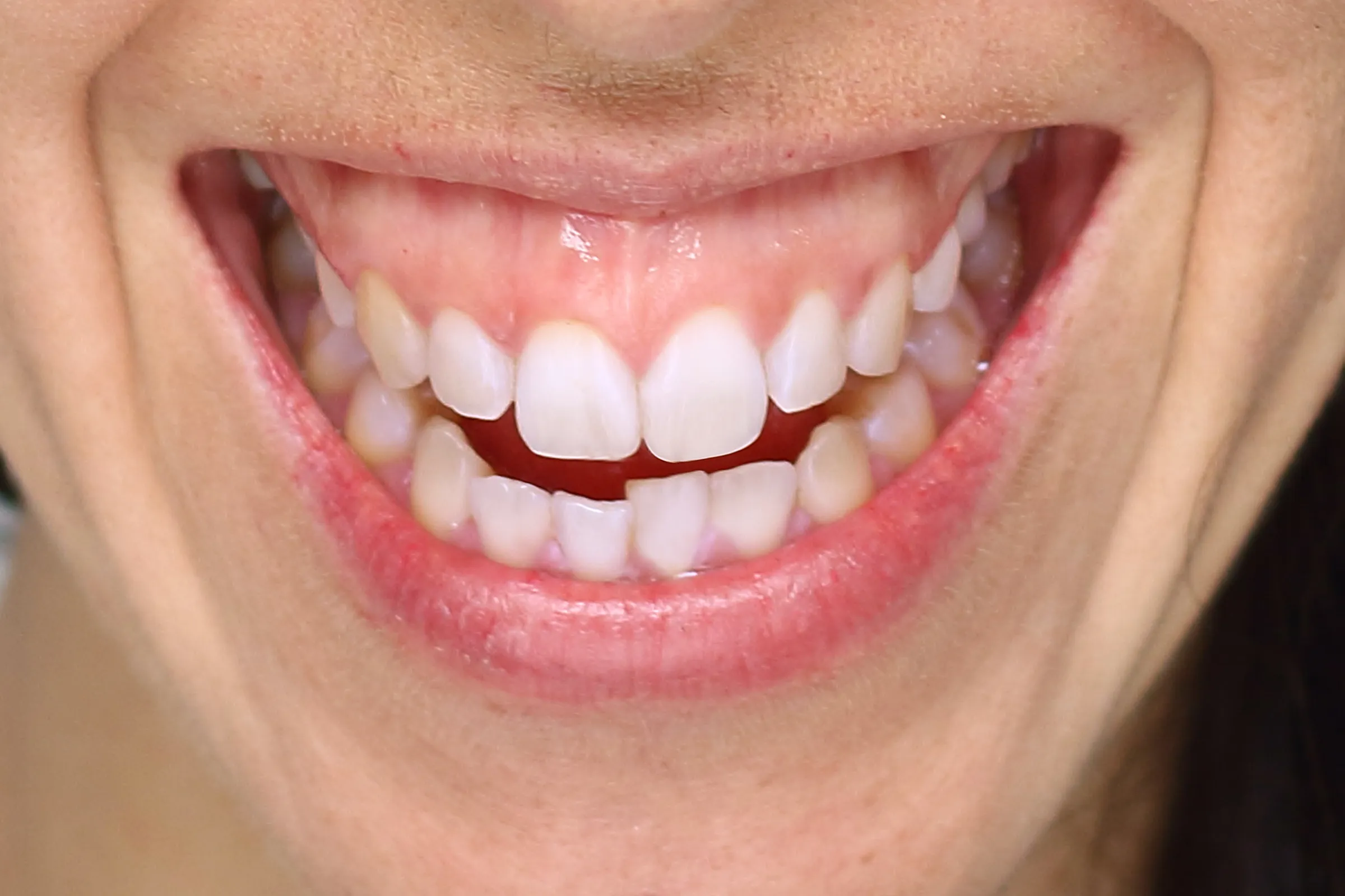 Close-up of a patient's gums and smile