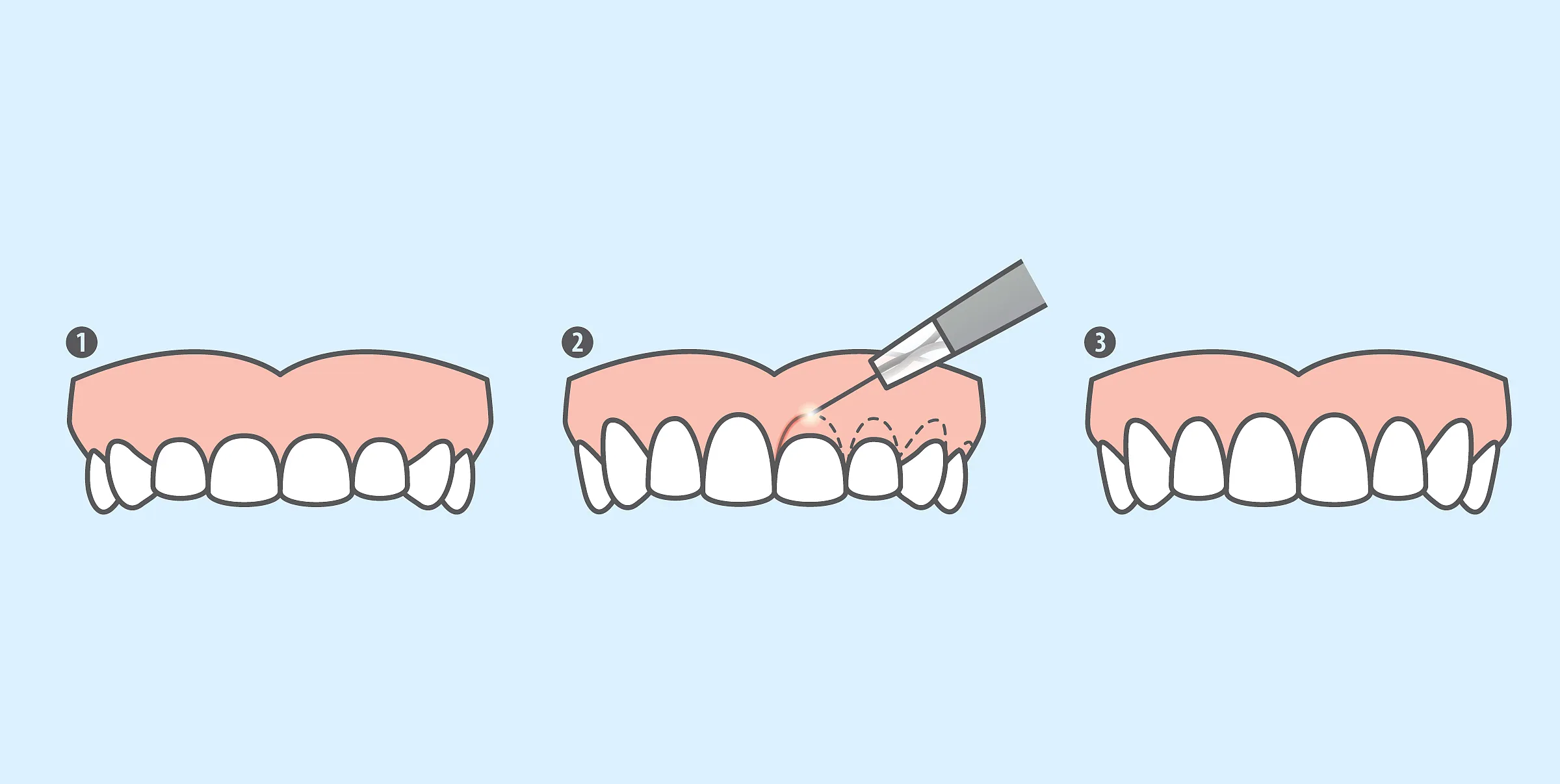 Patient smiling confidently after cosmetic gum treatment