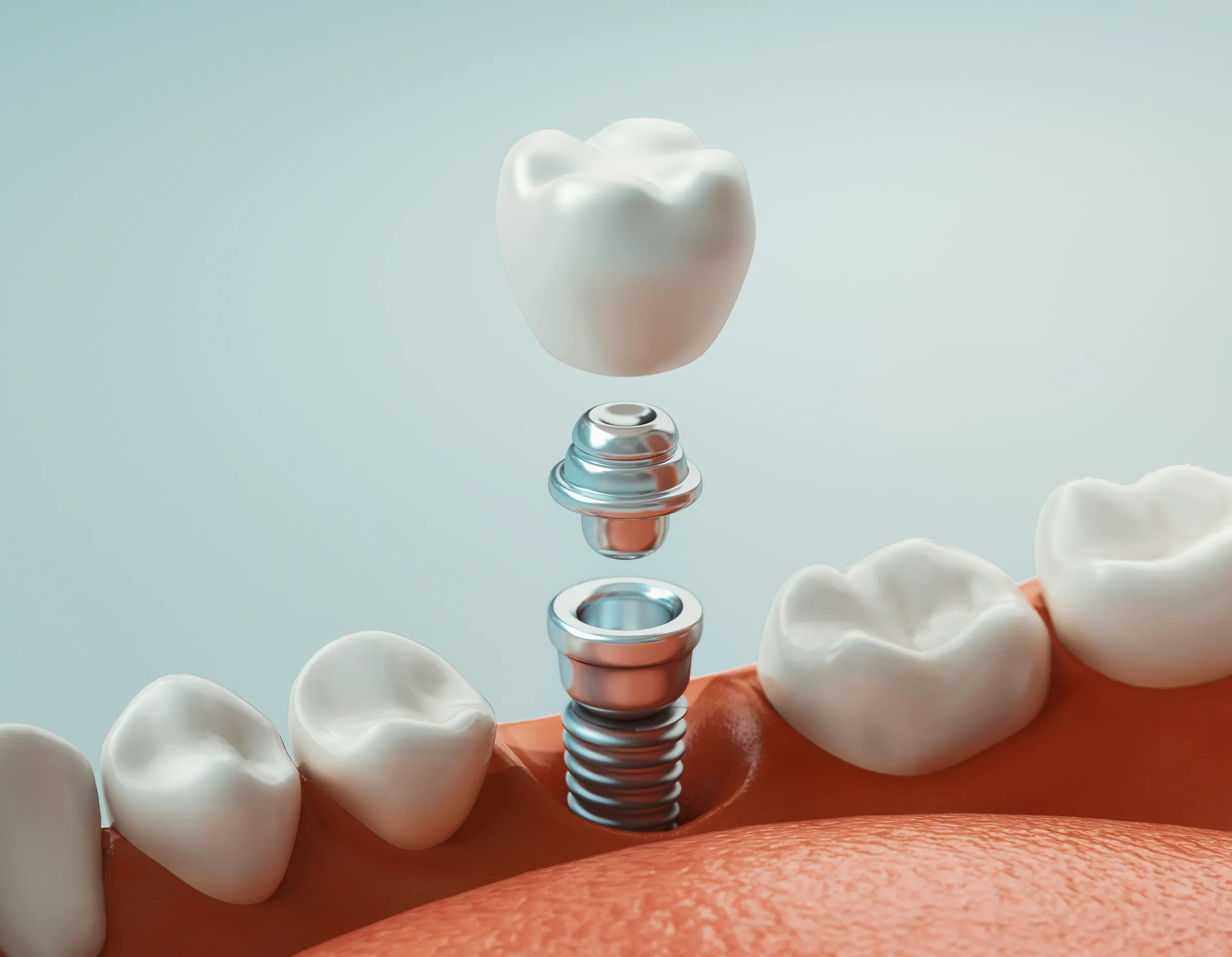 Dentist explaining a dental implant model to a patient