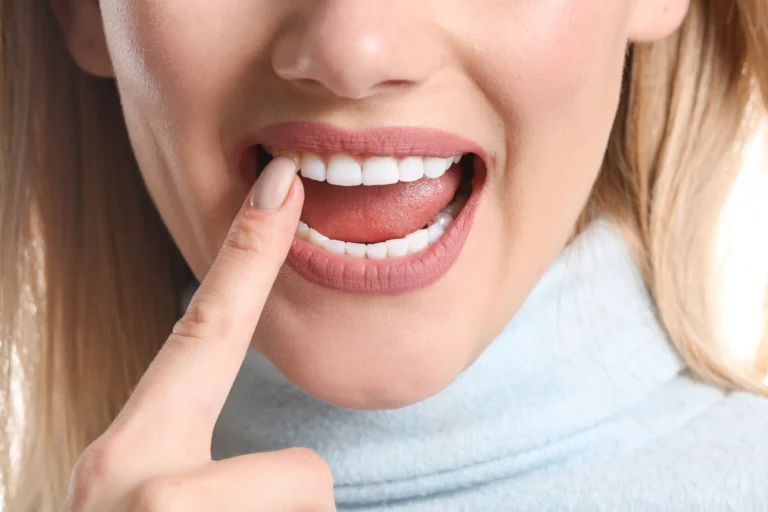Dental Sealants