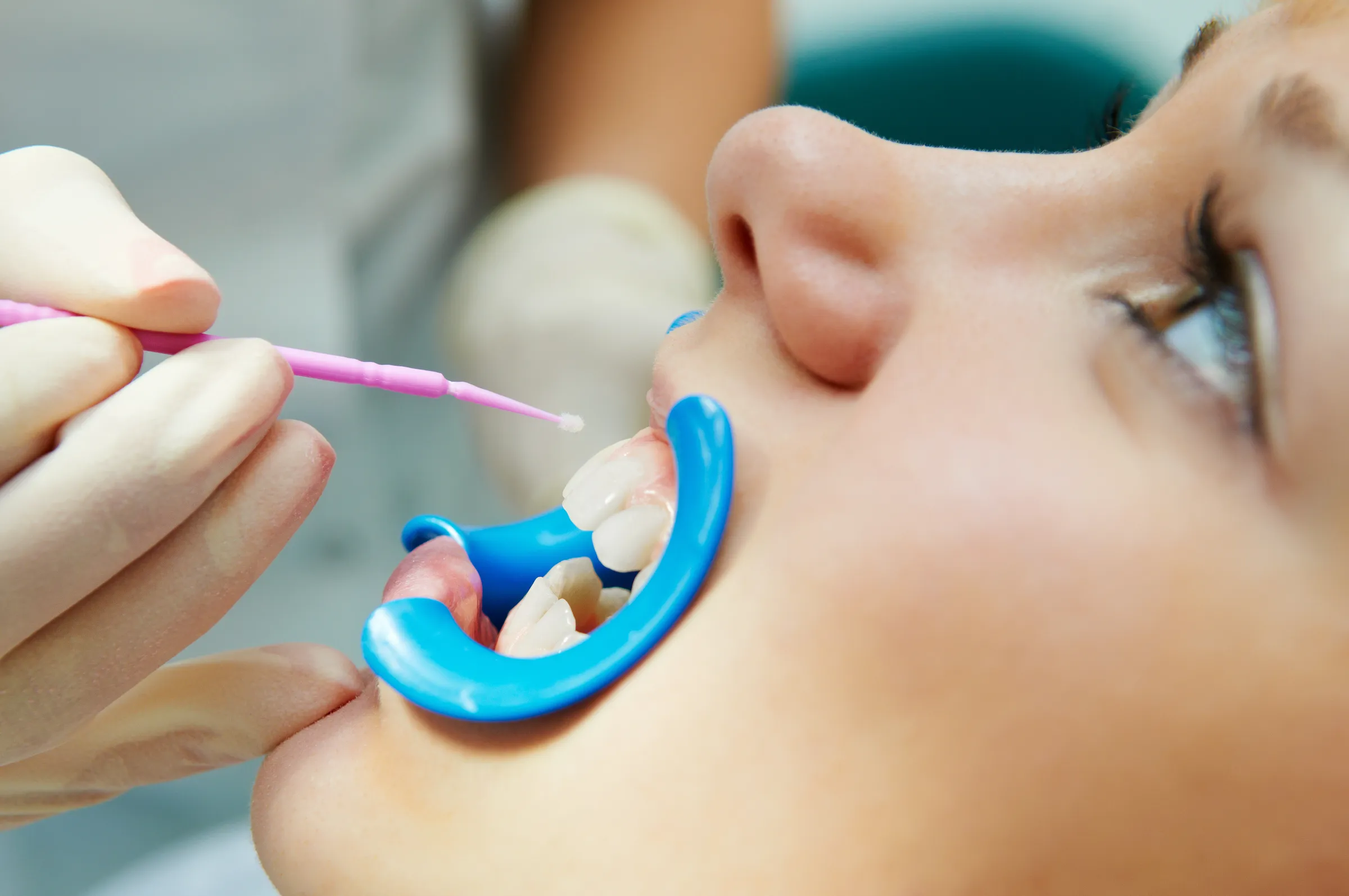 Dentist applying a sealant to a molar