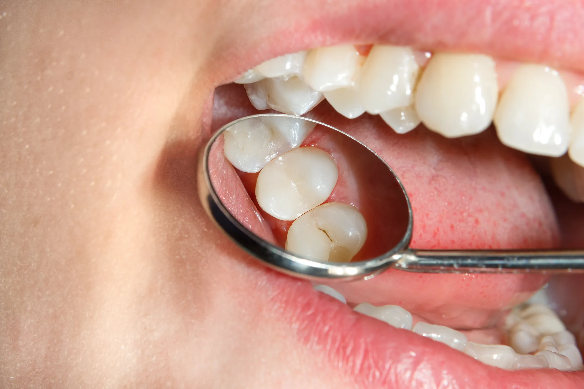 Dentist checking a sealant during a routine exam
