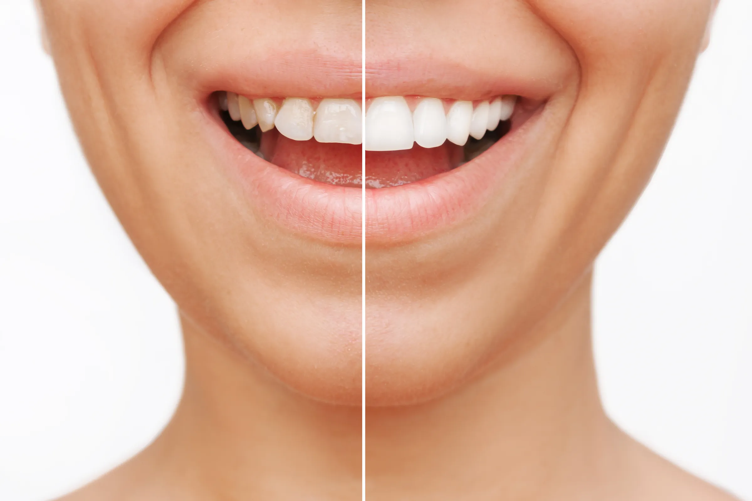 Patient smiling after completing a smile makeover