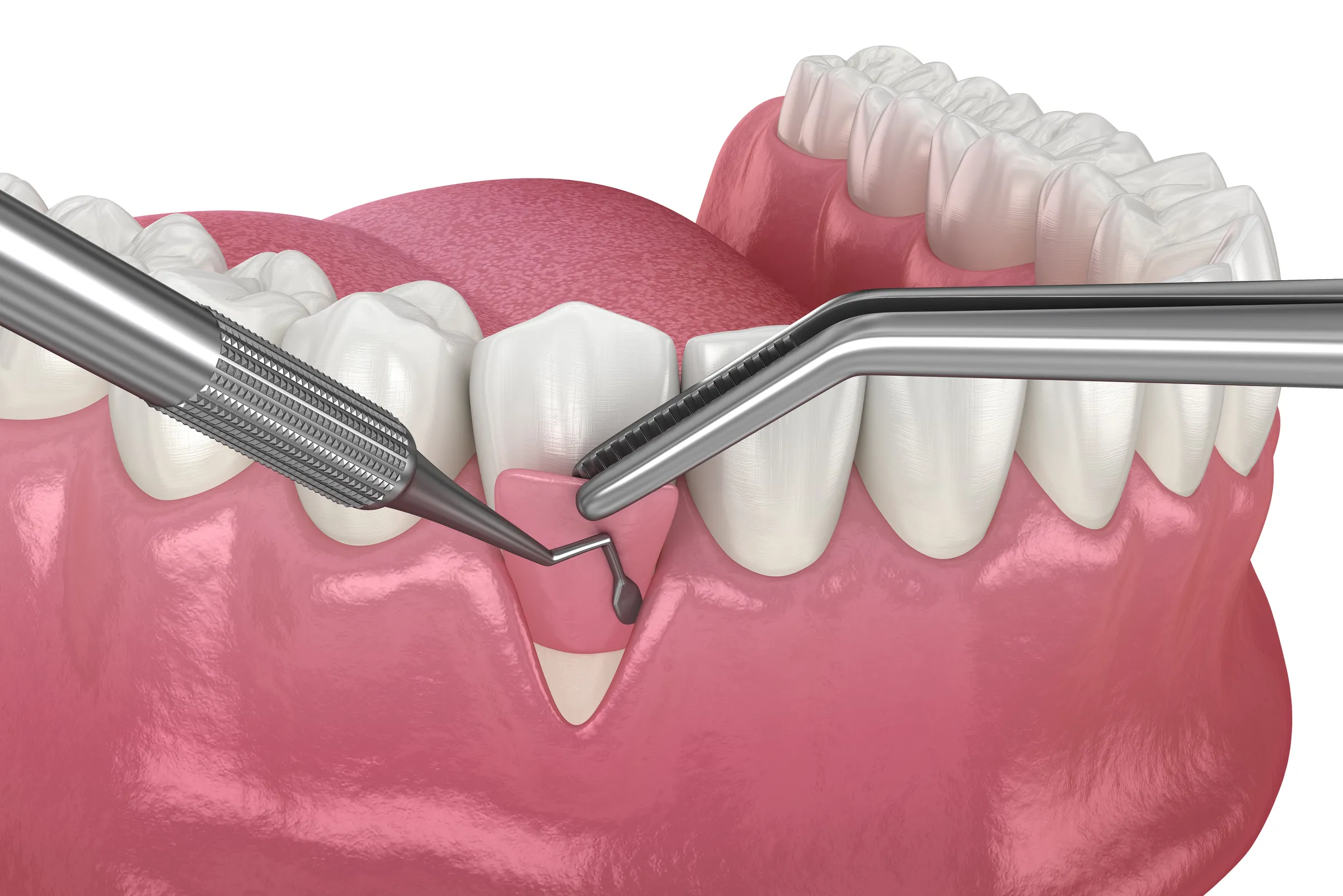 Patient at a follow-up visit after soft tissue grafting