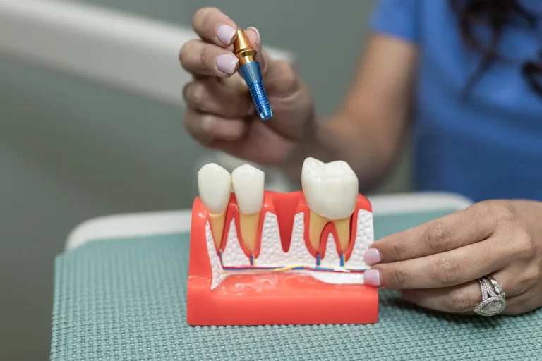 Dental Implants